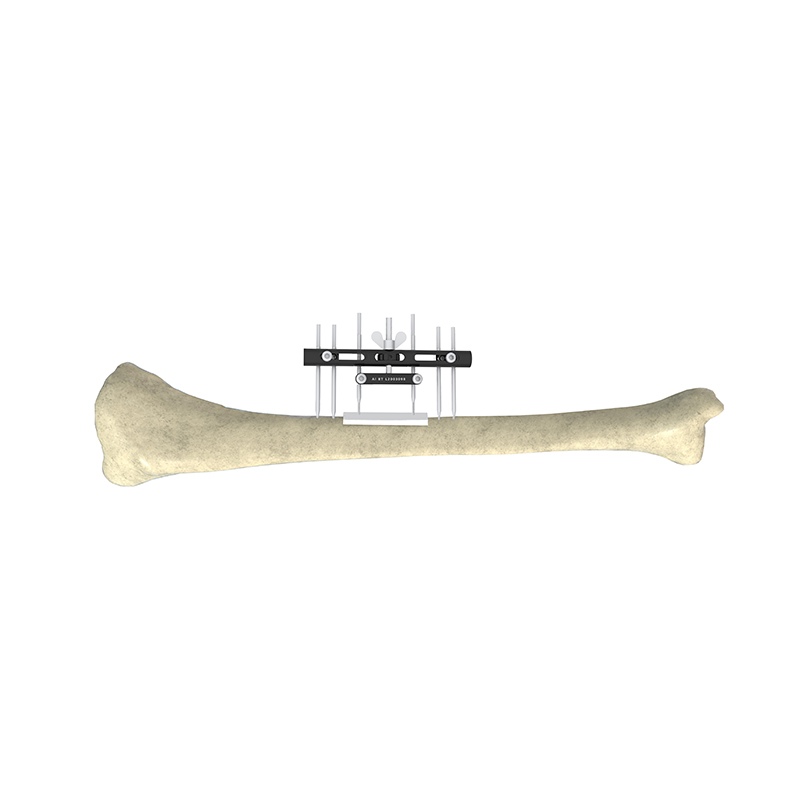  la endoprótesis externa de transporte óseo transversal