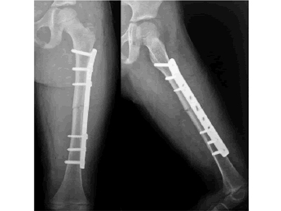 Orthopaedics Trauma Surgery Immediate postoperative x ray 12 2 16 g003