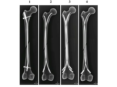 Frontal radiographs of femur models after fixation 1 One 55mm pediatric locking nail