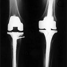 Knee joint X-ray