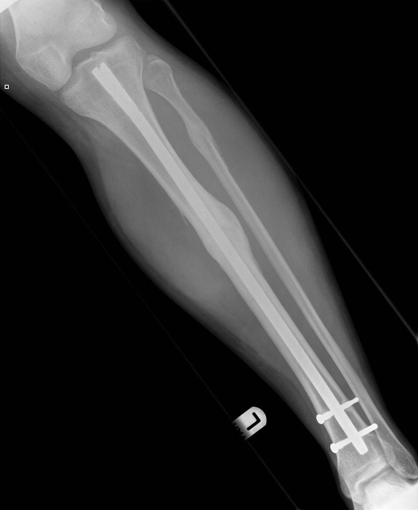 Tiba Nail X-ray Picture