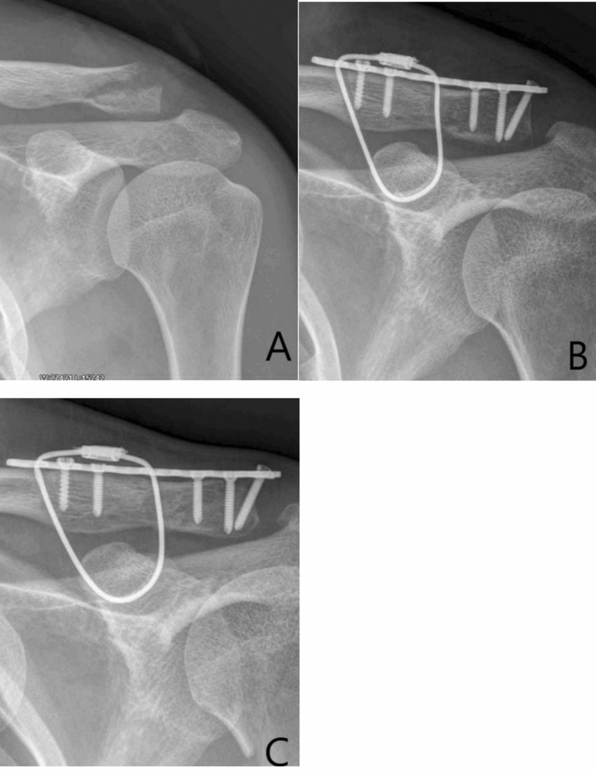 Cable fixng palte x-ray